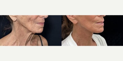 Case 11279 - 76 year old woman treated with Deep Plane Facelift, Neck Lift, Facial Fat Transfer, CO2 Laser