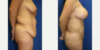 Case 1128 - 35-44 year old woman treated with Tummy Tuck