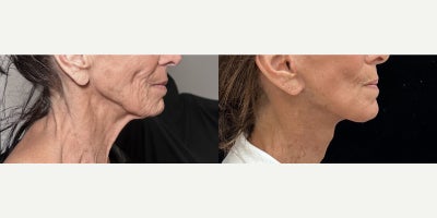 Case 11280 - 76 year old woman treated with Deep Plane Facelift, Neck Lift, Facial Fat Transfer, CO2 Laser