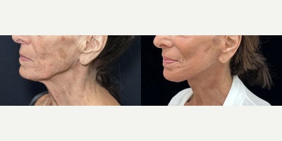 Case 11281 - 76 year old woman treated with Deep Plane Facelift, Neck Lift, Facial Fat Transfer, CO2 Laser