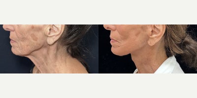Case 11282 - 76 year old woman treated with Deep Plane Facelift, Neck Lift, Facial Fat Transfer, CO2 Laser