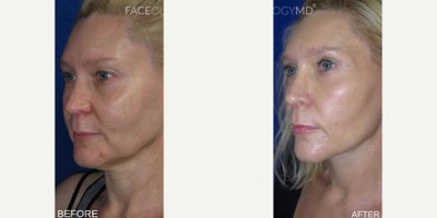 Case 11283 - Woman treated with Facelift, CO2 Laser, Eyelid Surgery