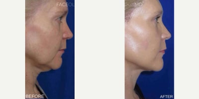 Case 11284 - Woman treated with Facelift, CO2 Laser, Eyelid Surgery