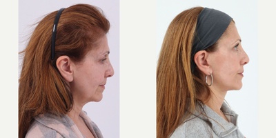 Case 11285 - 55-64 year old woman treated with Facelift, Neck Lift, CO2 Laser
