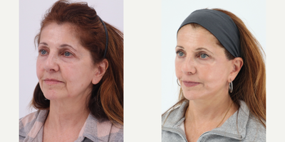 Case 11286 - 55-64 year old woman treated with Facelift, Neck Lift, CO2 Laser