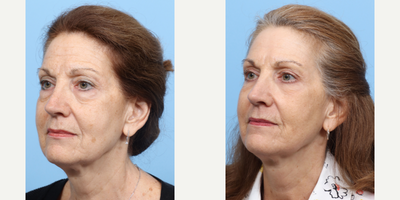 Case 11287 - 55-64 year old woman treated with Eyelid Surgery, CO2 Laser