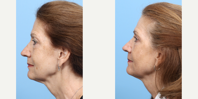 Case 11288 - 55-64 year old woman treated with Eyelid Surgery, CO2 Laser