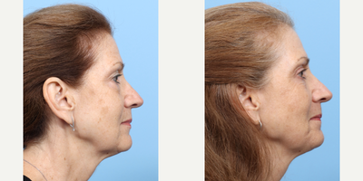 Case 11289 - 55-64 year old woman treated with Eyelid Surgery, CO2 Laser