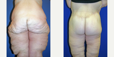 Case 1129 - 45-54 year old woman treated with Tummy Tuck