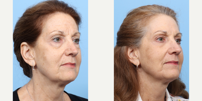 Case 11290 - 55-64 year old woman treated with Eyelid Surgery, CO2 Laser