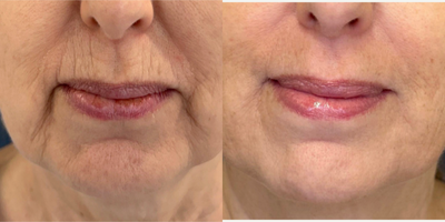 Case: 11291 - before and after photo of 55-64 year old woman treated with Microneedling RF, Microneedling by Glenn Lyle, MD
