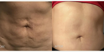 Case: 11292 - before and after photo of 45-54 year old woman treated with Secret Pro Radiofrequency Microneedling and CO2 by Svetlana M. Danovich, MD, PhD, FACS