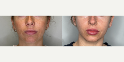 Case: 11293 - before and after photo of 25-34 year old woman treated with Microneedling, Chemical Peel by Falguni Patel, MD, FACOG