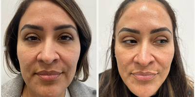 Case: 11294 - before and after photo of Woman treated with Microneedling, VI Peel, SkinPen by Matthew J. Nykiel, MD