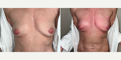 Case: 11295 - before and after photo of Woman treated with Microneedling, PRP Injections, for Breast Enhancement by undefined