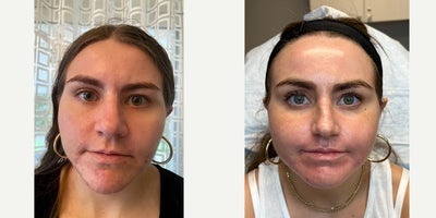 Case: 11296 - before and after photo of PERIORAL ACNE SCAR JOURNEY by Jason Emer, MD