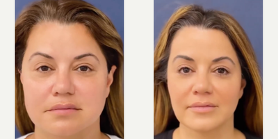 Case: 11297 - before and after photo of Woman treated with Microneedling, Buccal Fat Removal by Arash Moradzadeh, MD