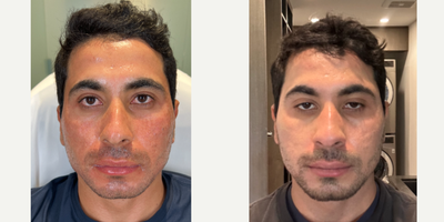Case: 11298 - before and after photo of STACKED ACNE SCAR COMBO by Jason Emer, MD