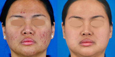 Case: 11299 - before and after photo of 25-34 year old woman treated with Accutane, IPL, Skin Tightening, Skin Rejuvenation, Chemical Peel, Microneedling by Monika Kiripolsky, MD