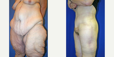 Case 1130 - 45-54 year old woman treated with Tummy Tuck