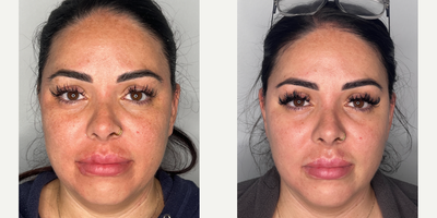 Case 11304 - 25-34 year old woman treated with Microneedling