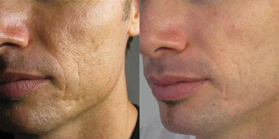 Case 11306 - Man treated with Microneedling
