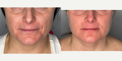 Case 11307 - 25-34 year old woman treated with Microneedling