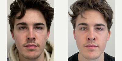 Case 11308 - 25-34 year old man treated with Microneedling