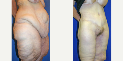 Case 1131 - 45-54 year old woman treated with Tummy Tuck
