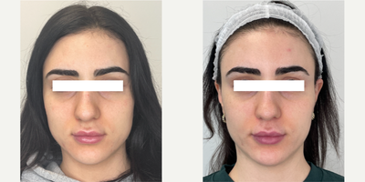 Case 11310 - 25-34 year old woman treated with Microneedling