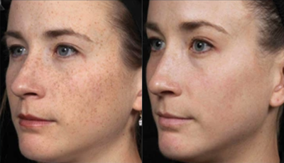 Case 11311 - Treated with Microneedling