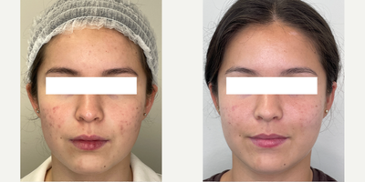 Case 11317 - 18-24 year old woman treated with Microneedling