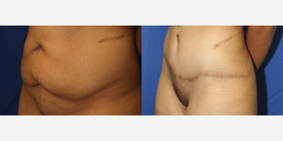 Case 1132 - Woman treated with Tummy Tuck