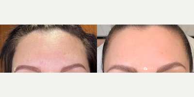 Case 11324 - Woman treated with Microneedling