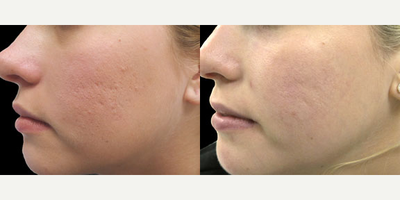 Case 11325 - 26 year old woman treated with Microneedling