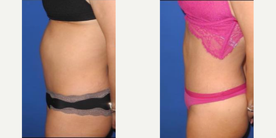 Case 1133 - Woman treated with Tummy Tuck