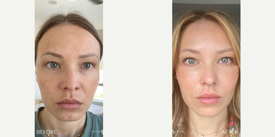 Case 11331 - Woman treated with Microneedling