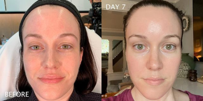 Case 11332 - Woman treated with Microneedling