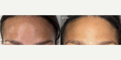 Case 11333 - Woman treated with Microneedling