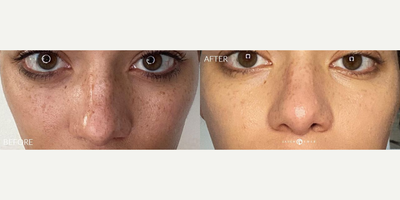 Case 11334 - Woman treated with Microneedling