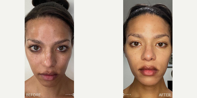 Case 11335 - Woman treated with Microneedling