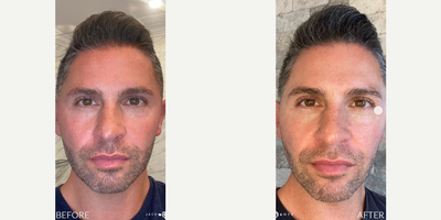 Case 11336 - Man treated with Microneedling