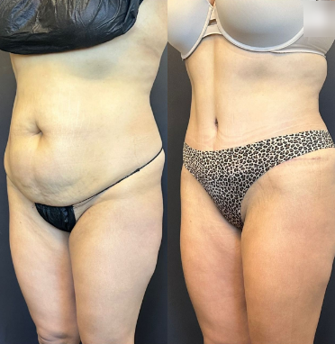 Case 1134 - Woman treated with Tummy Tuck