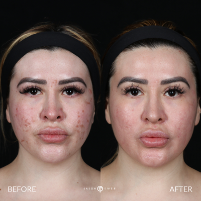 Case 11342 - 25-34 year old woman treated with Microneedling