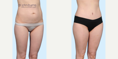 Case 1135 - Woman treated with Tummy Tuck