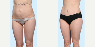 Case 1136 - Woman treated with Tummy Tuck