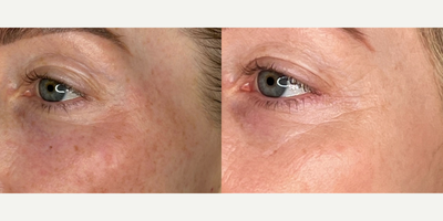 Case 11360 - 25-34 year old woman treated with Microneedling, SkinPen