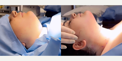 Case 11362 - Woman treated with Microneedling, Microneedling RF, Secret RF, Liposuction