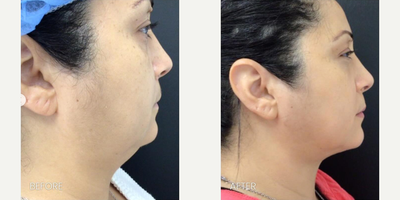 Case 11363 - Woman treated with Liposuction, Microneedling, Microneedling RF