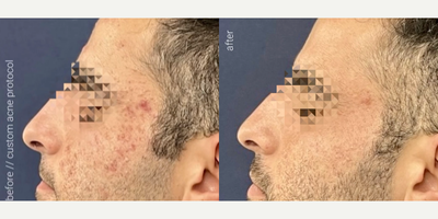 Case 11364 - Man treated with AviClear, Microneedling